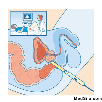 УЗИ простаты